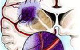 Phòng, trị rối loạn tuần hoàn não ở người cao tuổi